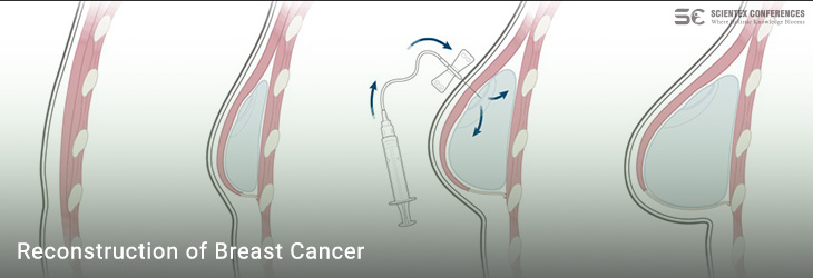 Reconstruction of Breast Cancer